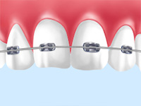 メタルブラケット（メタルブレイス/金属製のブラケットとワイヤーを併用した矯正装置）