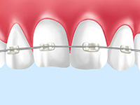 クリアブラケット（透明なブラケットとワイヤーを併用した矯正装置）
