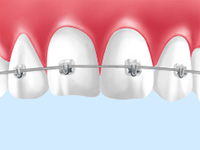 デーモンシステム（ブラケットとワイヤーを併用した矯正装置/オーコム社製）